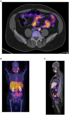 Agreement between PSMA-RADS and E-PSMA systems in classifying [18F]PSMA-1007 PET/CT lesions among prostate cancer patients: exploring the correlation between lesion size and uptake